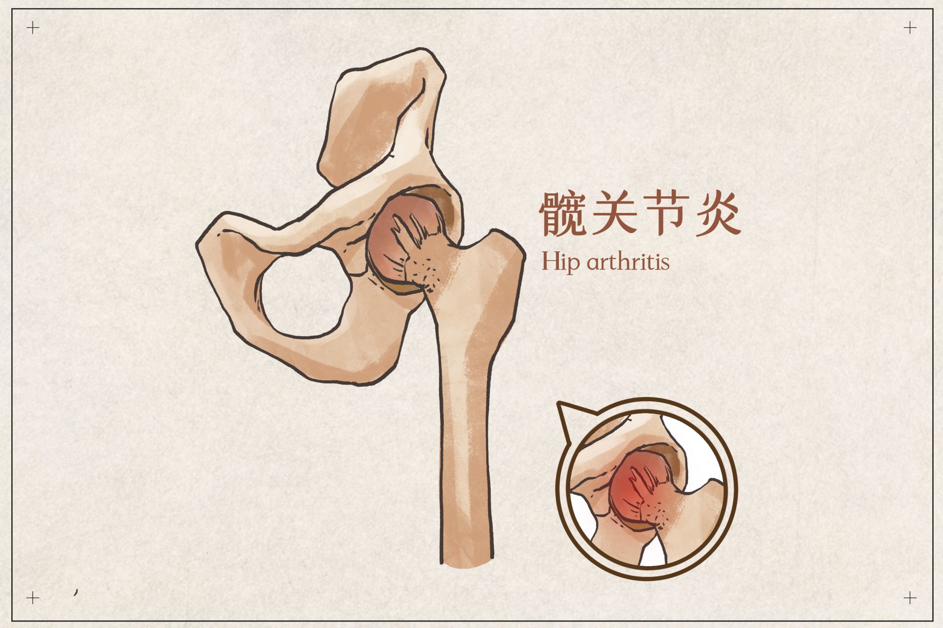 退化性關節炎